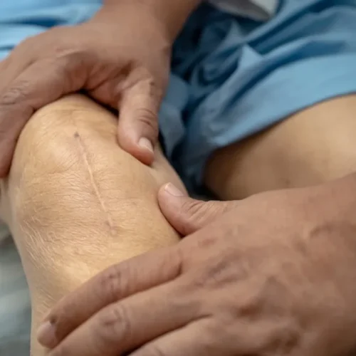 asian-senior-woman-patient-show-her-scars-surgical-2023-11-27-05-20-02-utc-Large-1024x682